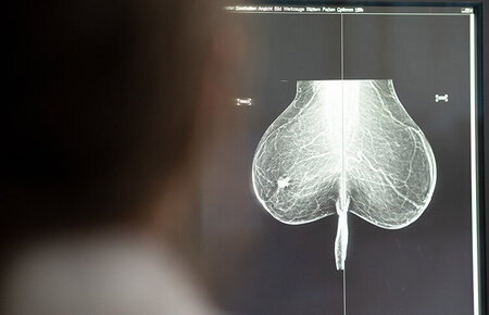 Ärztin vor einem Bildschirm, der eine Mammographie-Aufnahme einer Brust mit Brustkrebs zeigt.