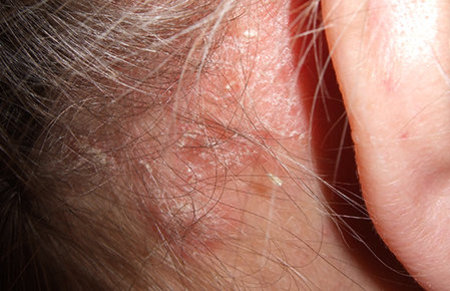 Psoriasisarthritis auf der Haut hinter dem Ohr