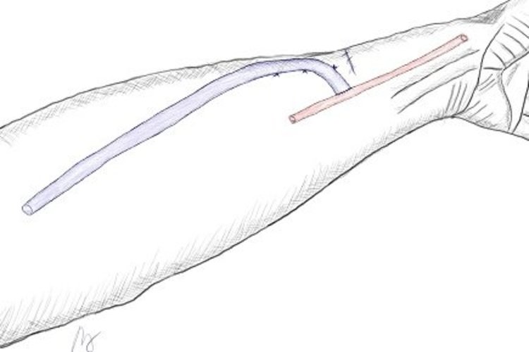 Bleistiftzeichnung eines Unterarms, die eine Zugang zu einem Gefäß mittels eines Shunts zeigt
