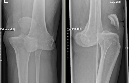 Die Röntgenbilder bestätigen den Verdacht auf eine Kniegelenksluxation