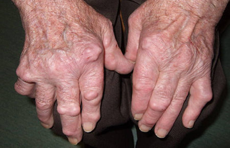 Rheumatoide Arthritis mit Rheumaknoten