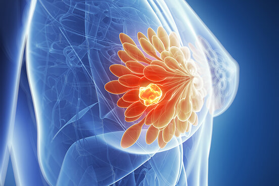 Dreidimensionale Illustration eines Tumors in der Brust