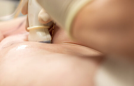 Nahaufnahme eines Ultraschallkopfes auf der Haut zusammen mit einer Nadel für eine Regionalanästhesie