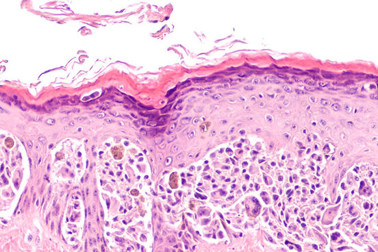 Mikroskopische Aufnahme von Hautkrebszellen