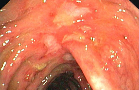 Entzündung des Dickdarms bei Morbus Crohn