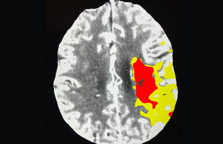 Das rot markierte Gewebe ist der Infarktkern und der gelb markierte Bereich zeigt das noch zu rettende Hirngewebe an.