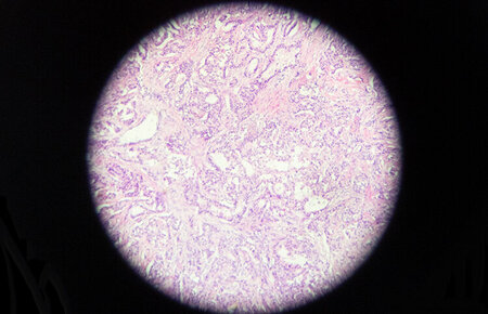 Mikroskopische Aufnahme einer Tumorzelle