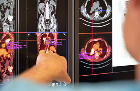 Arzt zeigt mit seiner Hand auf den Bildschirm mit einer nuklearmedizinischen Aufnahme