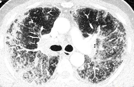 Sarkoidose verursacht Entzündungen in der Lunge